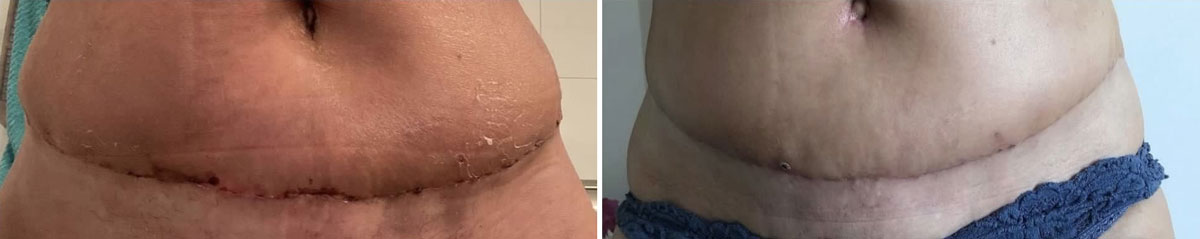 Lymphdrainage
