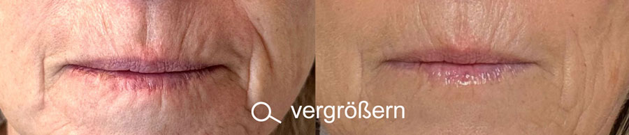 Hifu Zum Vergroessern